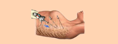 Sympathectomie Thoracique Solution Chirurgicale contre la Transpiration Excessive